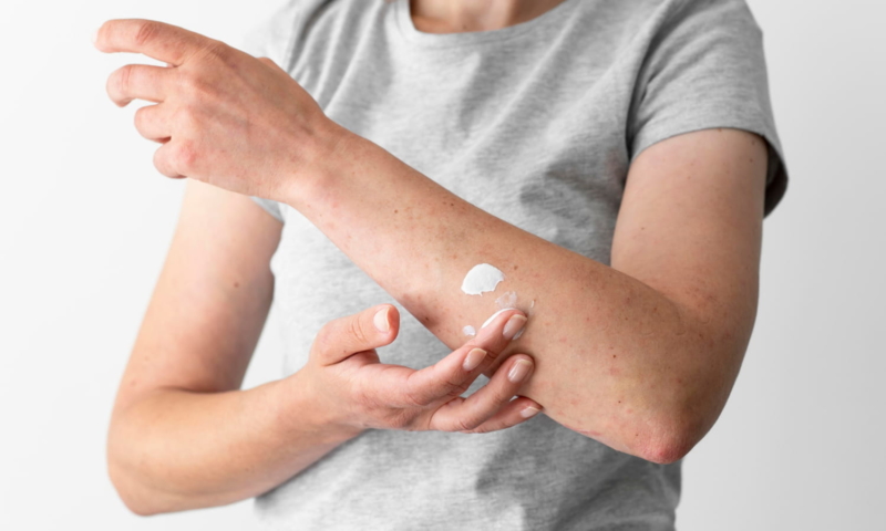 lady with skin allergy rubbing cbd cream into arm