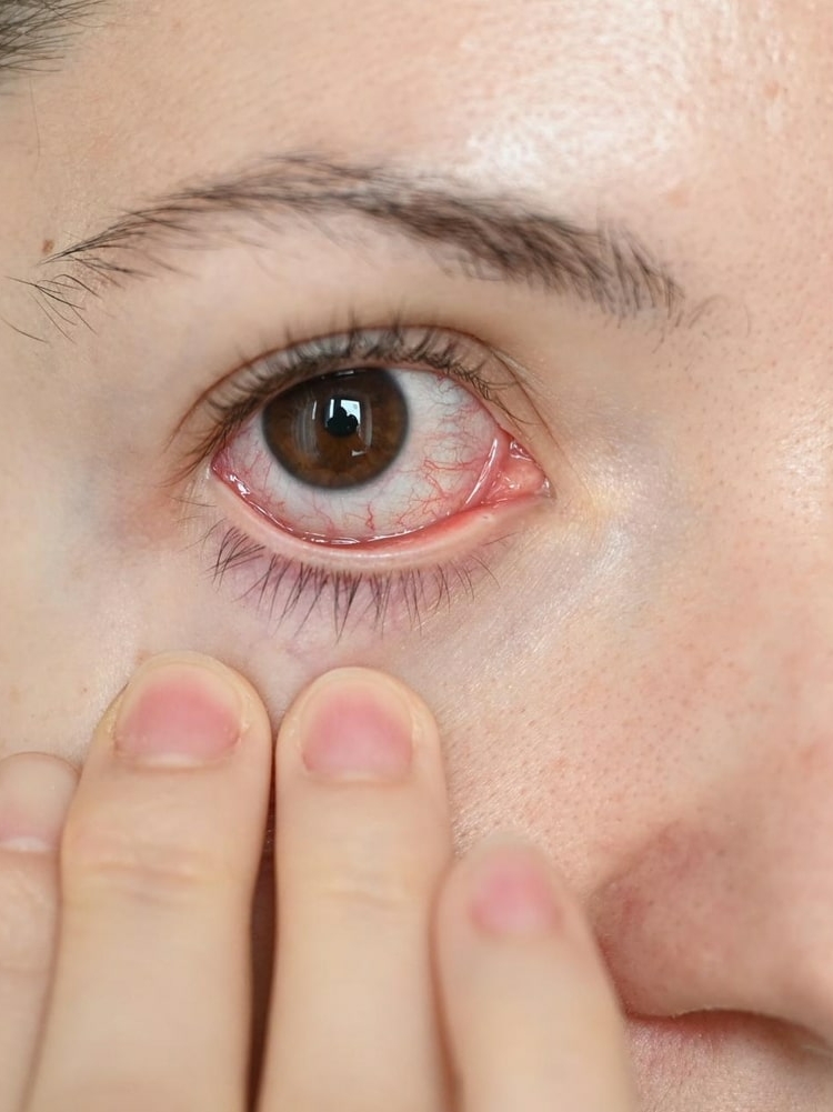 Lady with eye inflammation