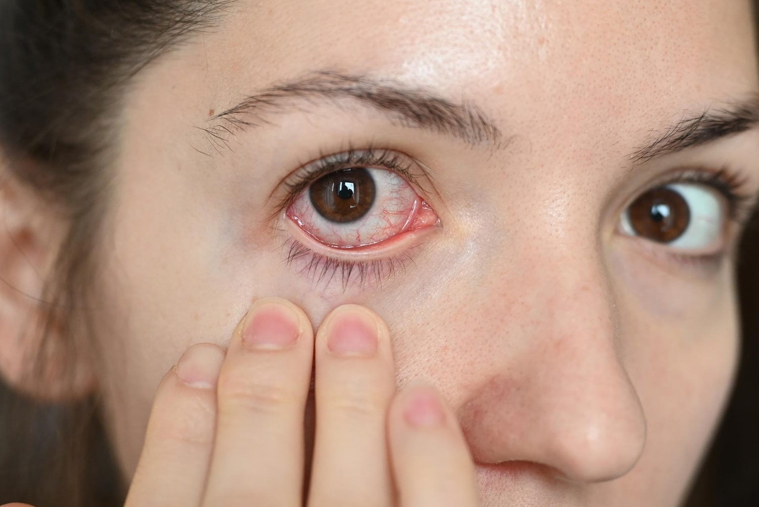 Lady with eye inflammation